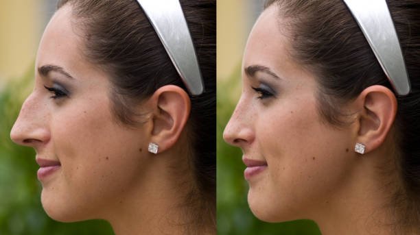 Rhinoplasty surgery in Riyadh