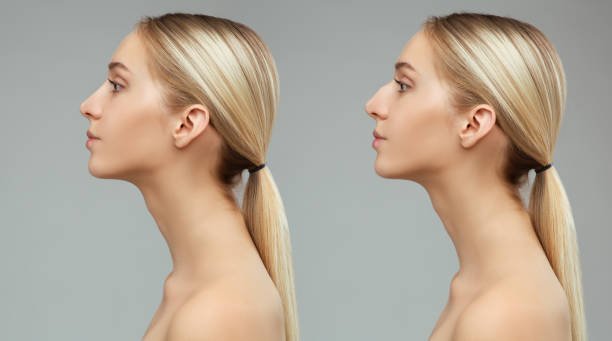Rhinoplasty surgery in Riyadh