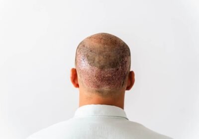 hair-transplant-riyadh