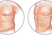 Revolutionize Your Shape with Liposuction Services in Riyadh