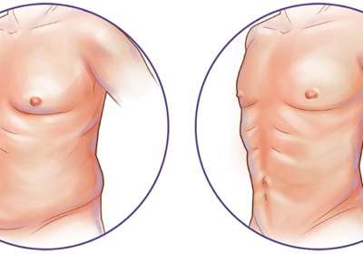 liposuction-chest-abdomen