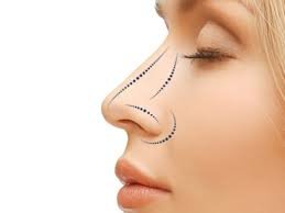 rhinoplasty-riyadh