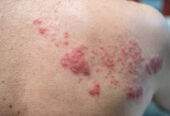 Shingles with pictures
