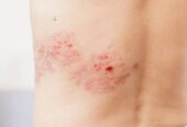 Shingles with pictures