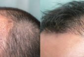 Hair Transplant in Riyadh