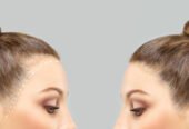 Hair Transplant in Riyadh