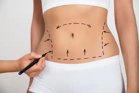 Your Complete Resource for Liposuction in Riyadh