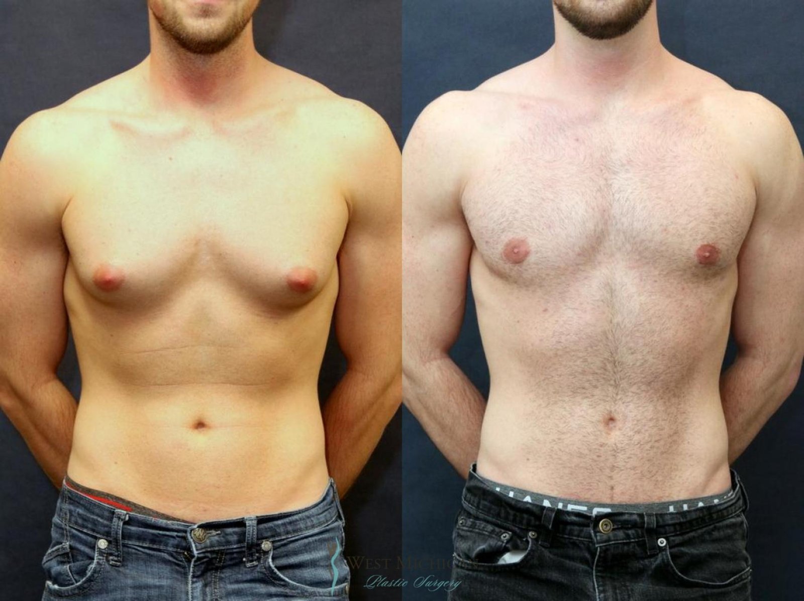 Gynecomastia Surgery in Riyadh