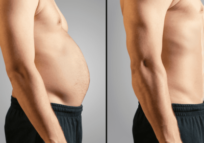 beforeafterofliposuction