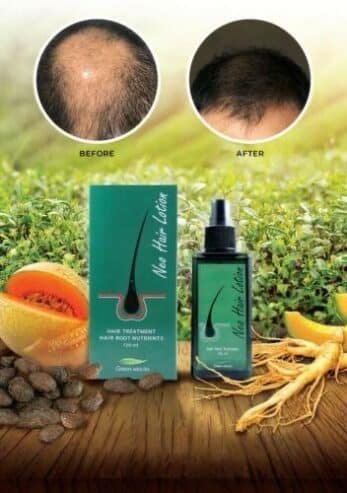 Hair Loss Don’t Worry