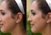 Rhinoplasty surgery in Riyadh