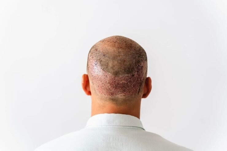 hair transplant in riyadh