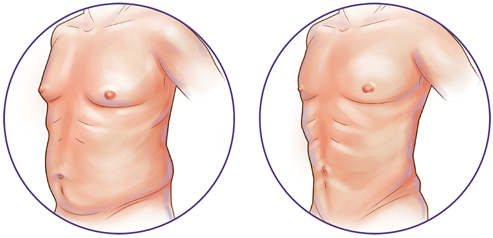 Revolutionize Your Shape with Liposuction Services in Riyadh