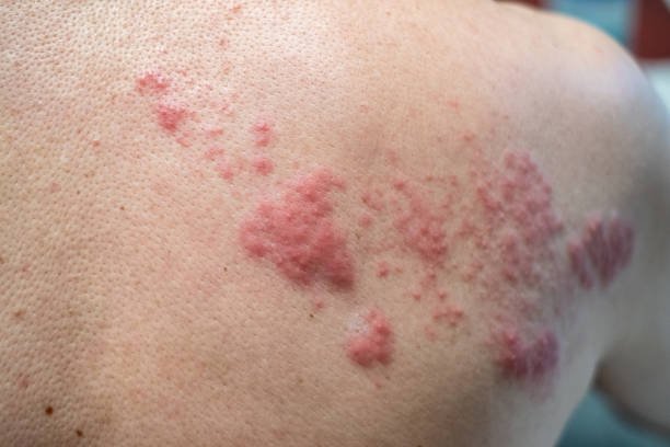 Shingles with pictures