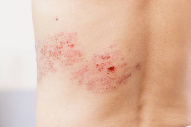 Shingles with pictures