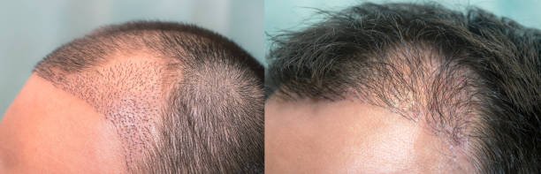 Hair Transplant in Riyadh