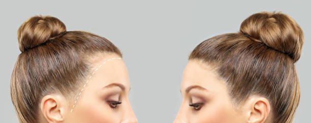 Hair Transplant in Riyadh