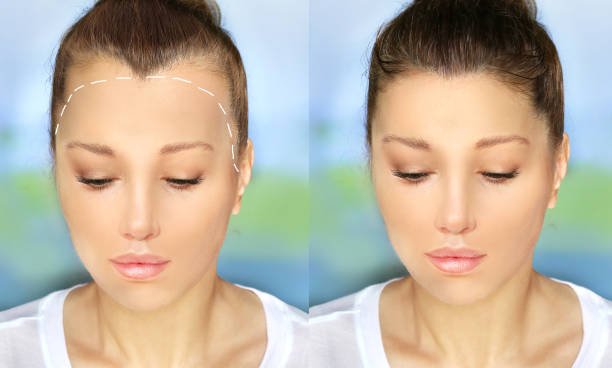 Hair Transplantation in Riyadh