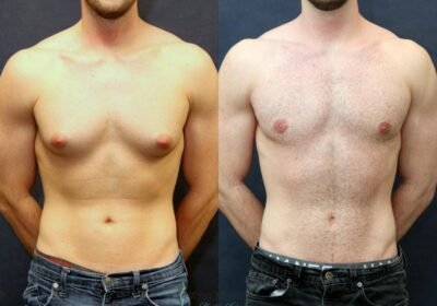 gynecomastia-8733-view-1-detail