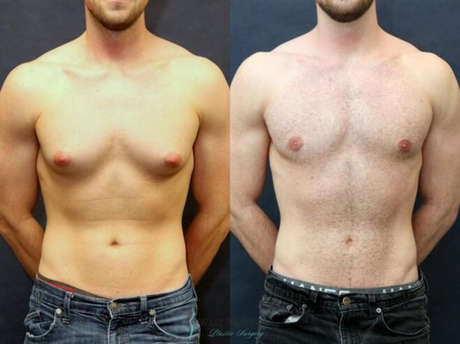Gynecomastia Surgery in Riyadh